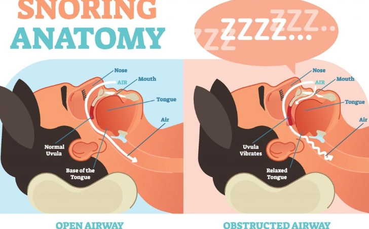 snoring solutions