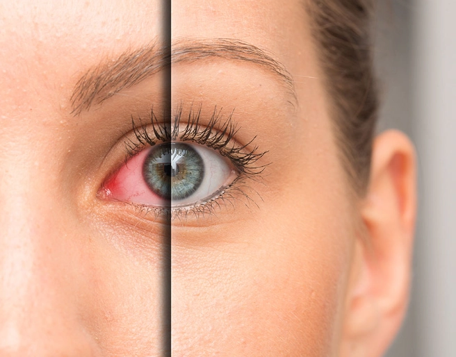 dark circles vs normal eyes