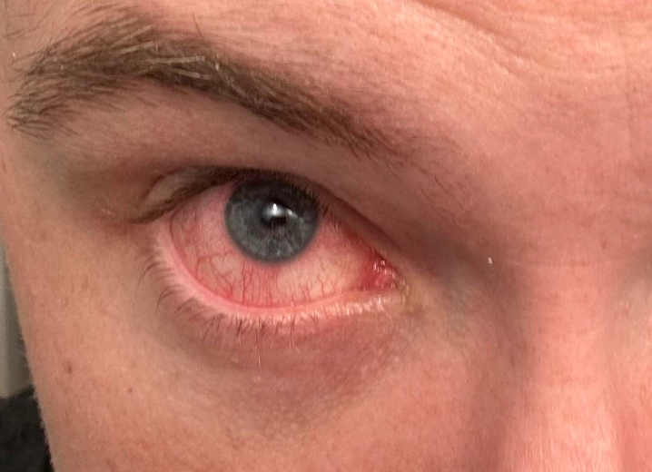 red eyes from lack of sleep