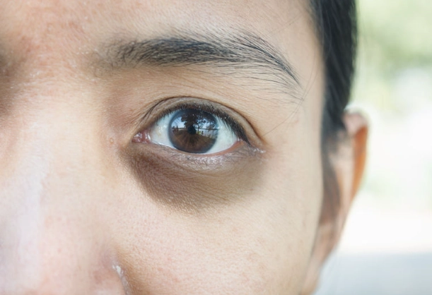 puffy eyes sleep deprivation