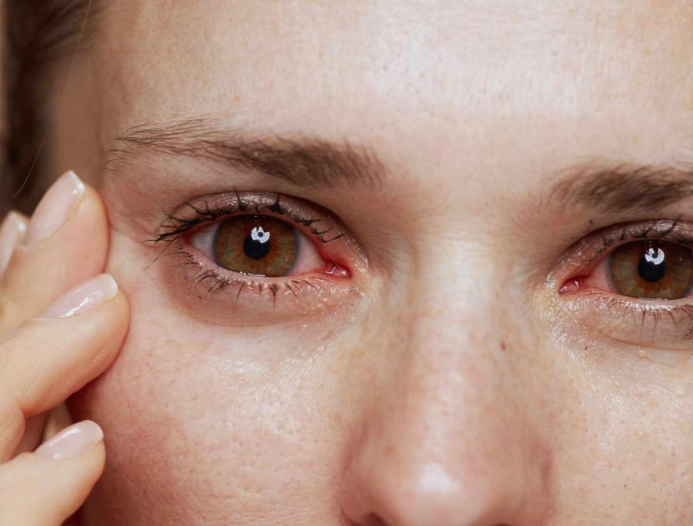 how to stop eye twitching