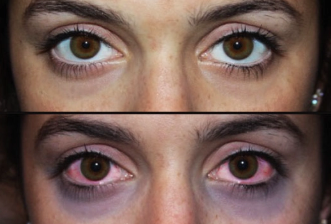 puffy eyes sleep deprivation