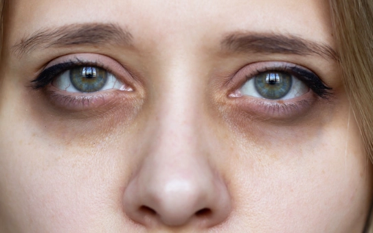 sleep deprivation red eyes