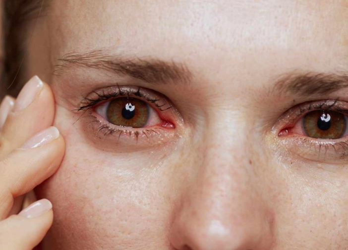 Sleep deprivation eyes