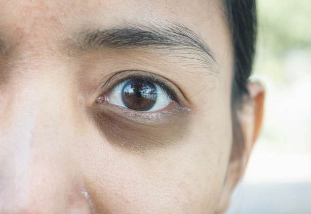 how to fix sleep deprived eyes