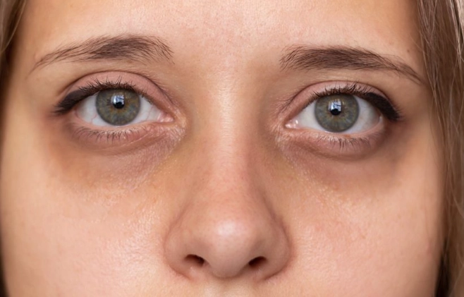 puffy eyes from lack of sleep